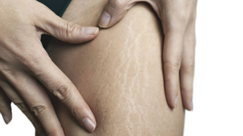 Stretch Marks Treatment Cost